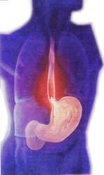 What Causes Heartburn?